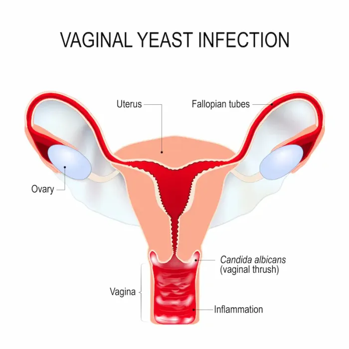 What Leads to Signs of a Vaginal Yeast Infection